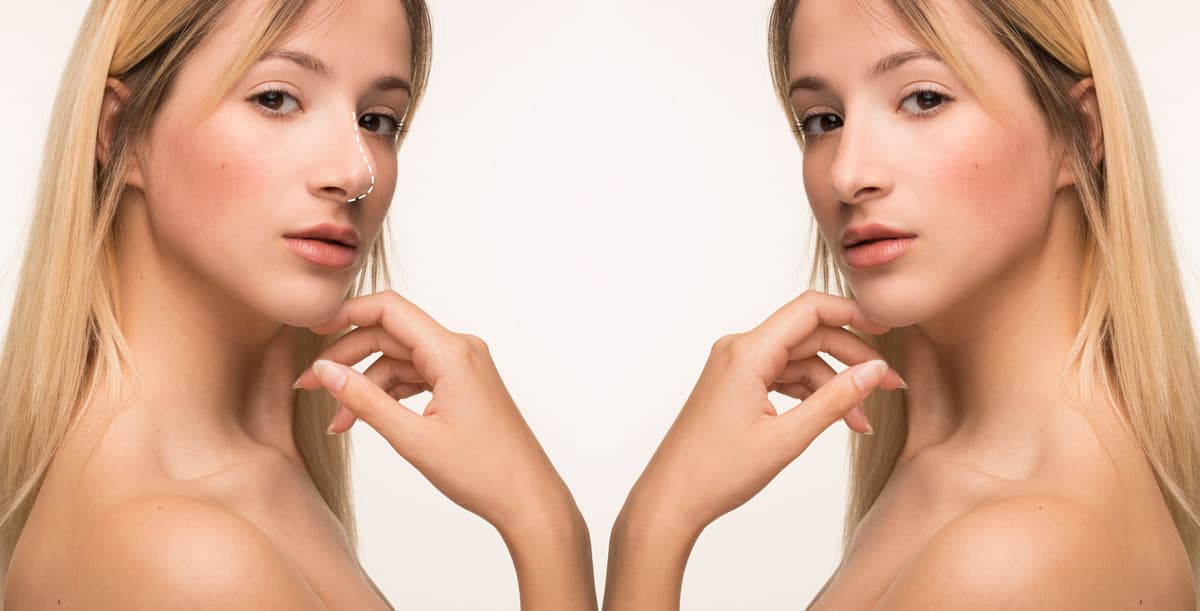 rinoplastica aperta o chiusa