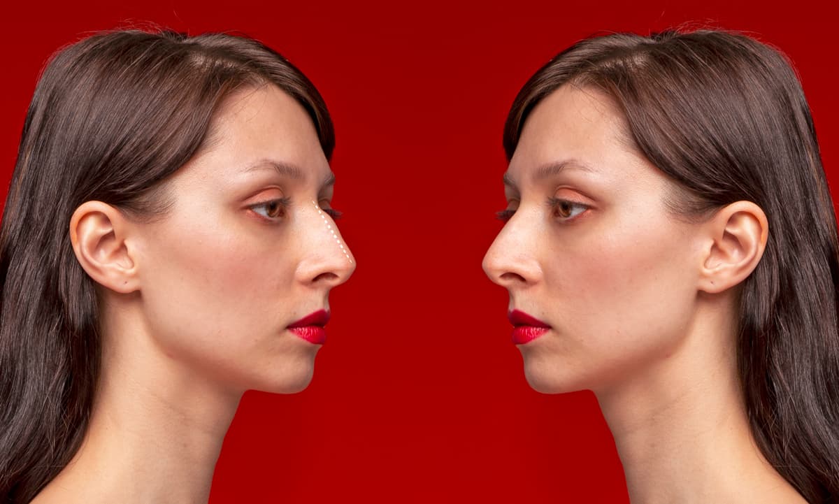 eliminare la gobba dal naso