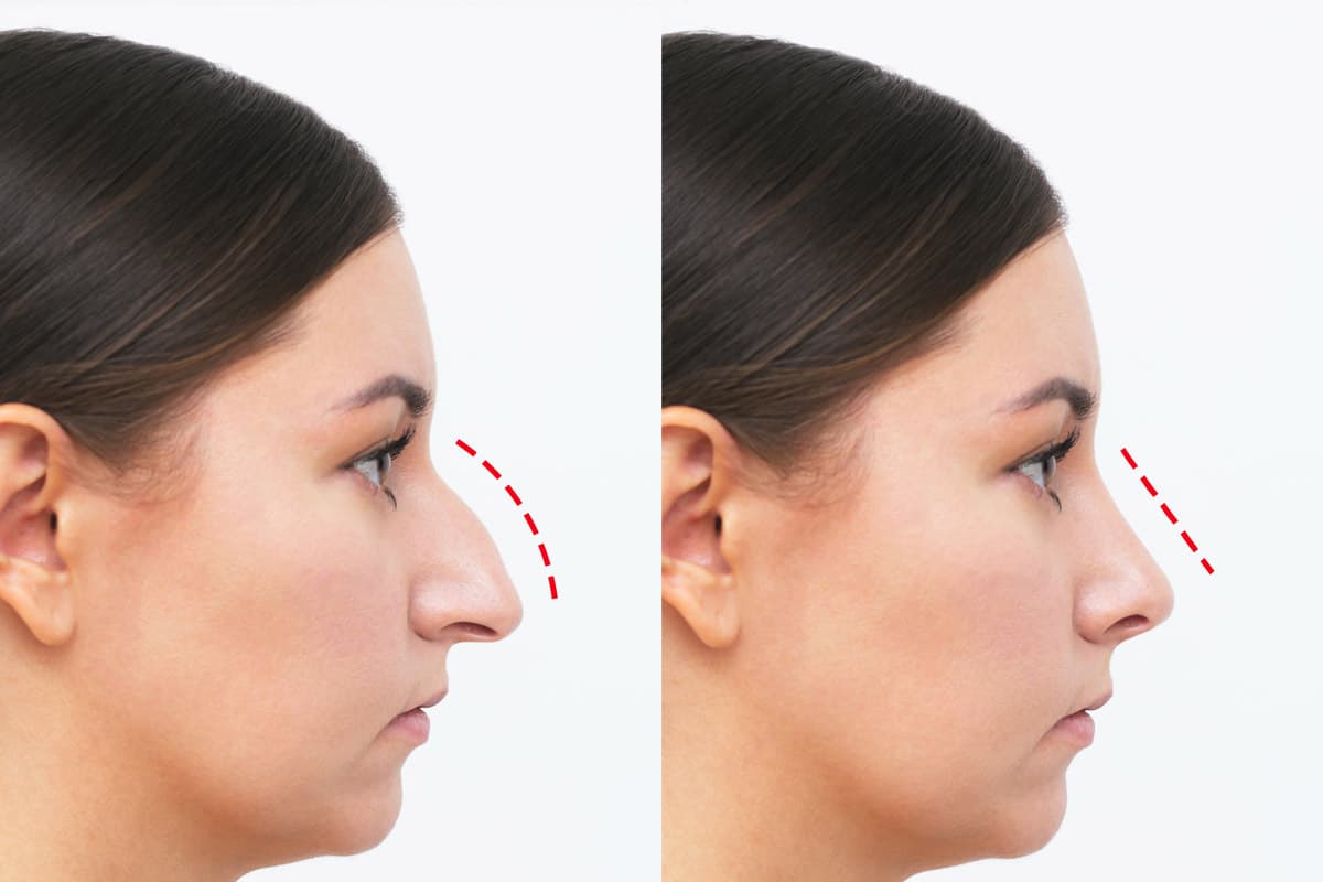 rinoplastica terziaria