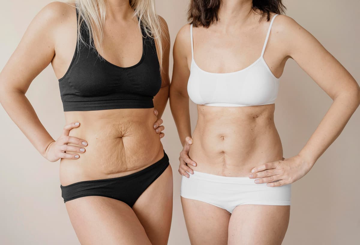 mommy makeover